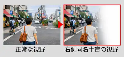 同名半盲による視野欠損